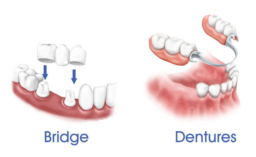 Eximus Dental 1-5-845x518-1 Implants Philippines  