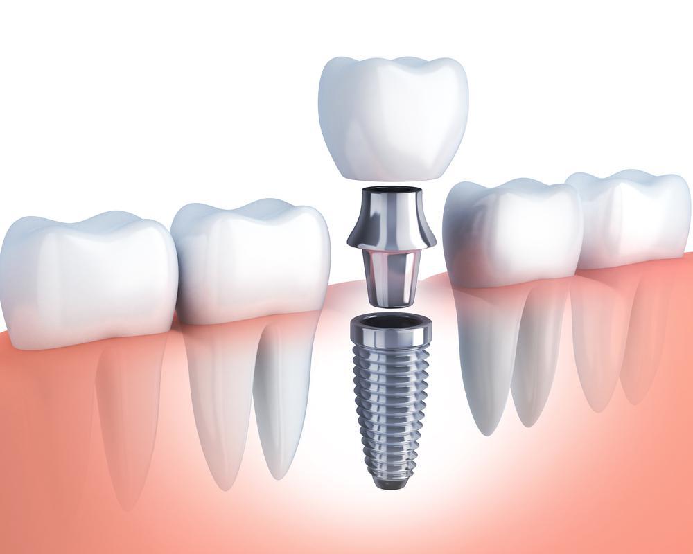 Eximus Dental 2261138 Implants Philippines  