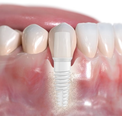 Eximus Dental All-you-need-to-know-about-CeramicZirconia-implants Implants Philippines  