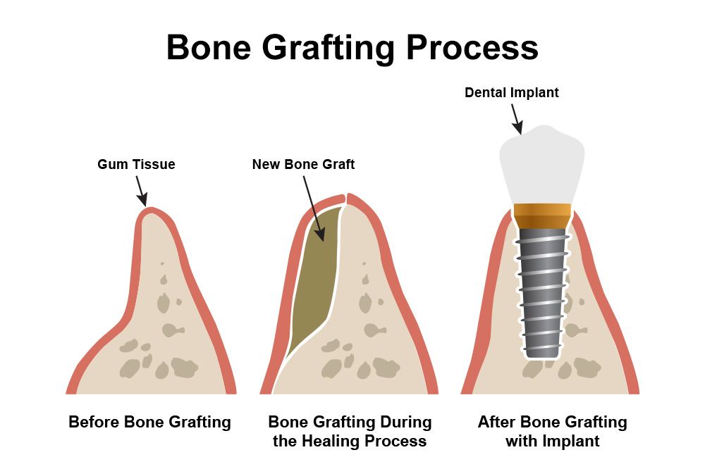 Eximus Dental Bone_Grafting_Process Our Services  