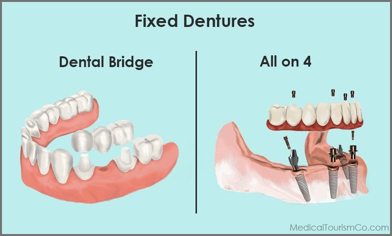 Eximus Dental BridgeVSAllon4 Implants Philippines  