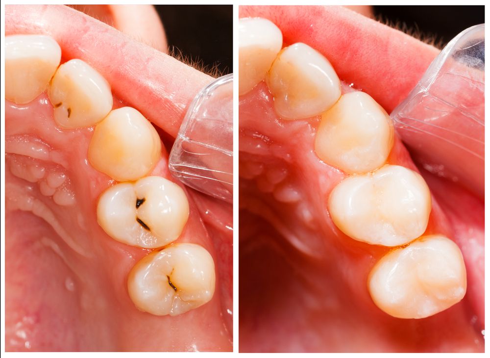 Eximus Dental Composite-Tooth-Colored-Fillings.jpg.optimal Our Services  