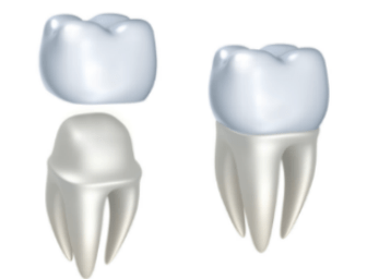 Eximus Dental Fental-crown-2 Home  