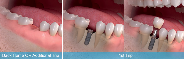 Eximus Dental Immediate-Loaded-Dental-Implants Implants Philippines  