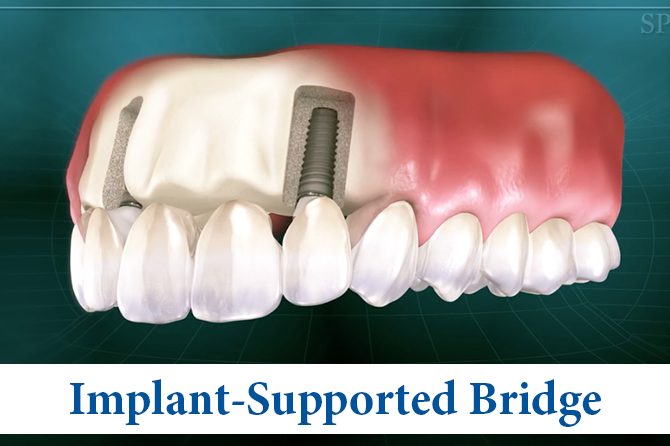 Eximus Dental Implant-Supported-Bridge2 Implants Philippines  