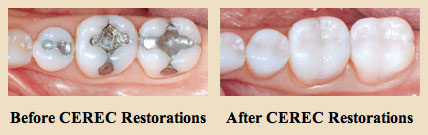 Eximus Dental cerec_before_after-1 Our Services  