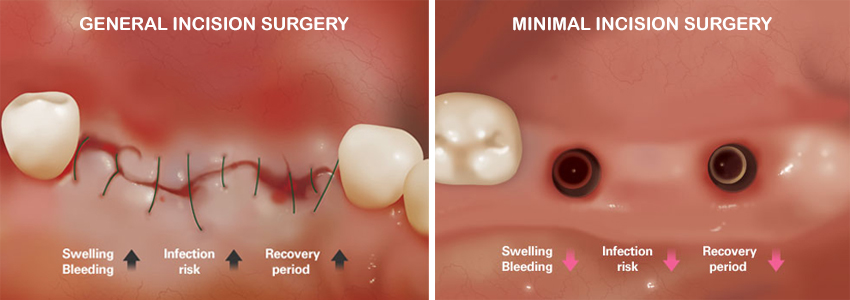 Eximus Dental dental-implant Implants Philippines  