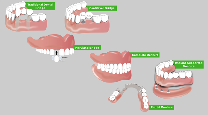 Eximus Dental dentures-bridges-720 Implants Philippines  