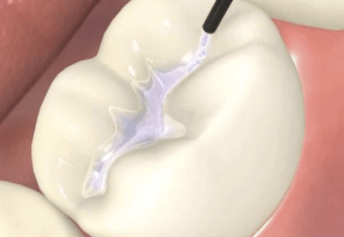 Eximus Dental filling-2 Home  