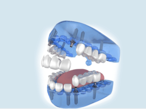 Eximus Dental image-4-300x225 What Are Dental Implants?  