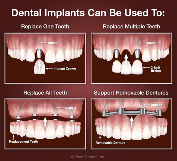 Cost of Dental Implants in the Philippines