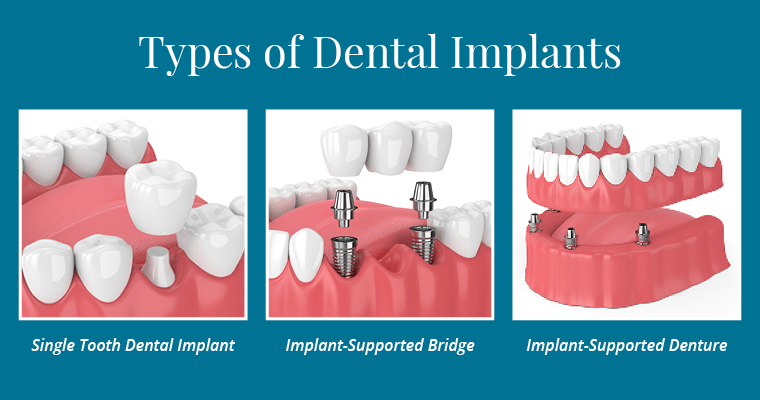 Eximus Dental implant-dentistry-types Implants Philippines  