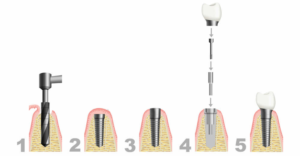 Eximus Dental implant-procedure Implants Philippines  