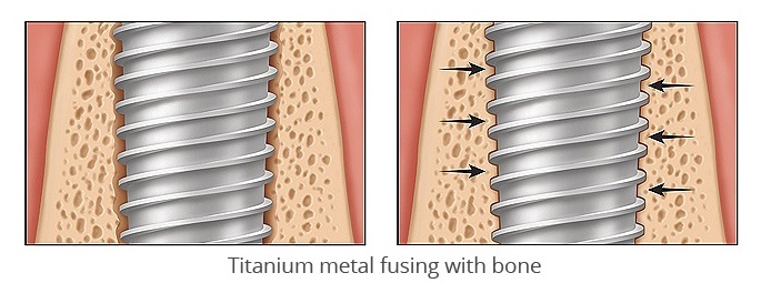 Eximus Dental osseointegration1-1 Implants Philippines  