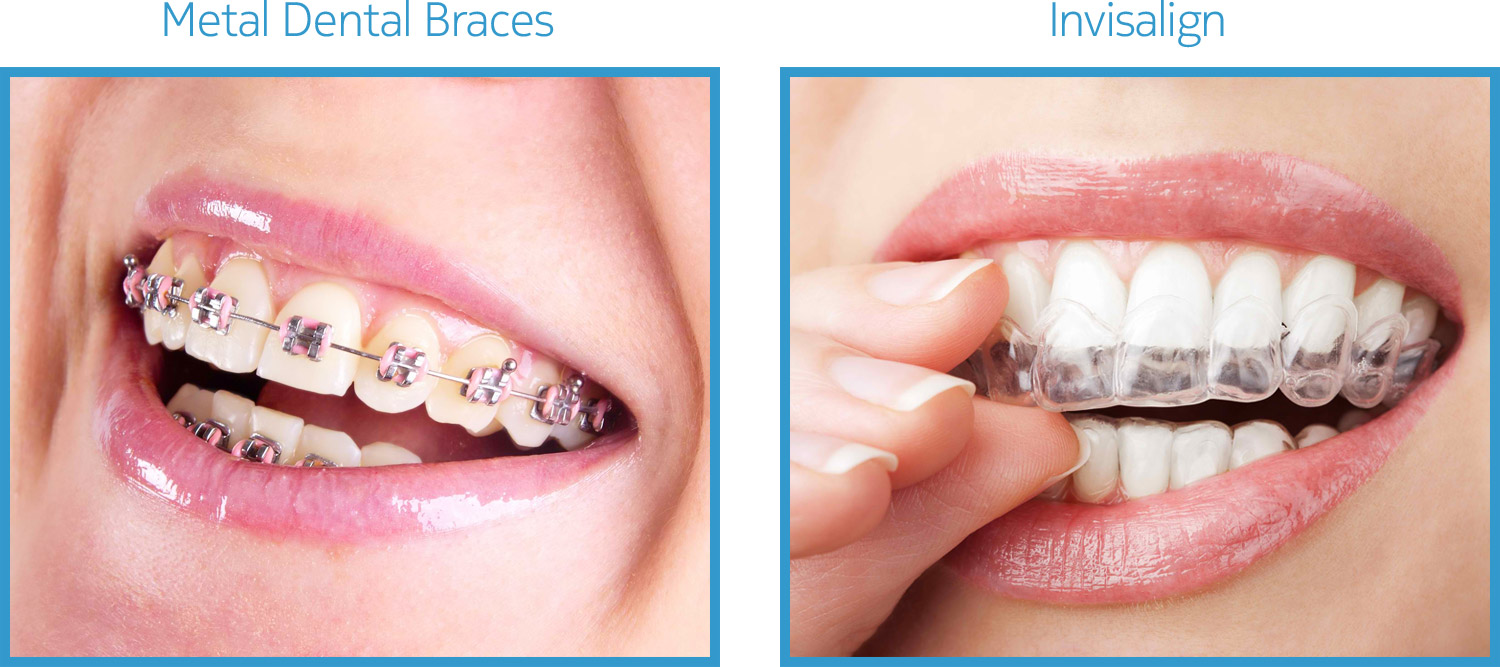 Eximus Dental service-dental-braces-01_0 Our Services  