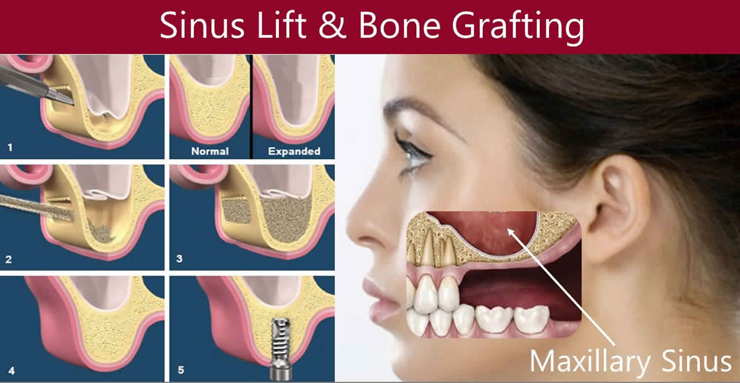 Eximus Dental sinus-lift Our Services  