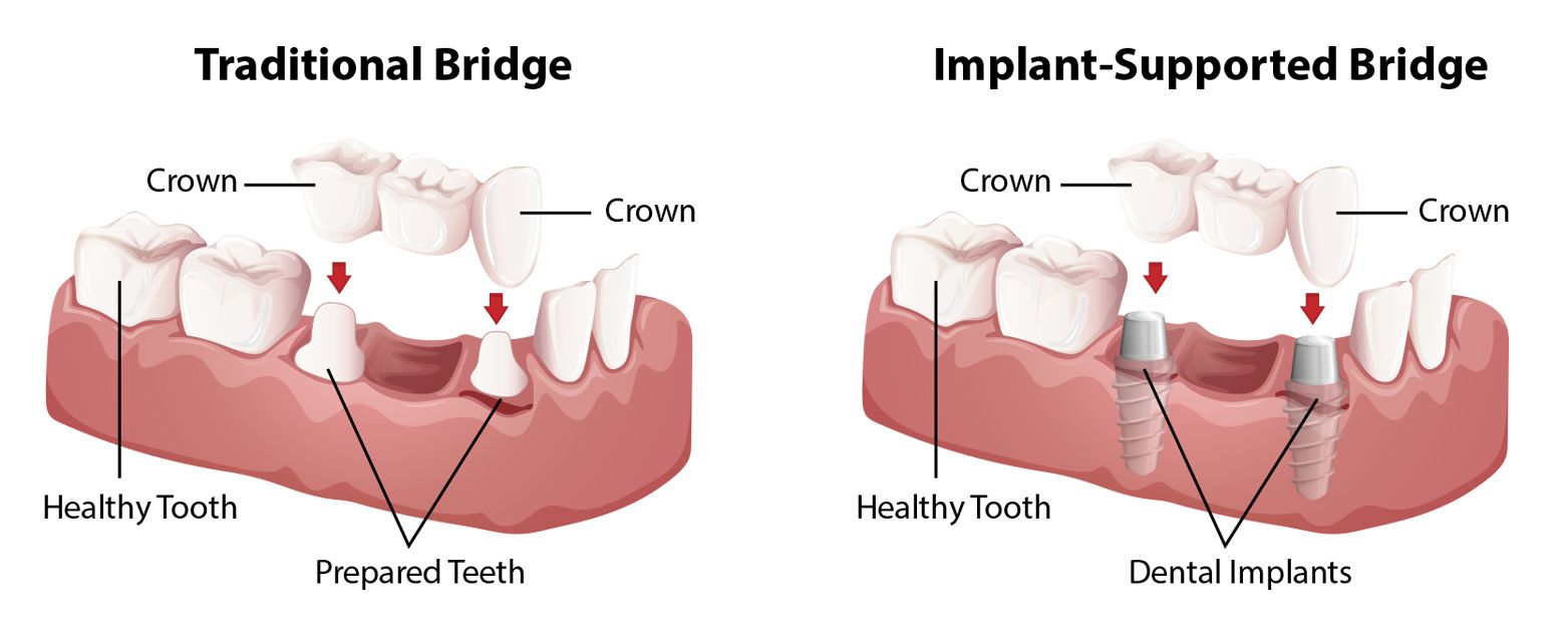 Eximus Dental traditionalbridge-vs-implant Implants Philippines  