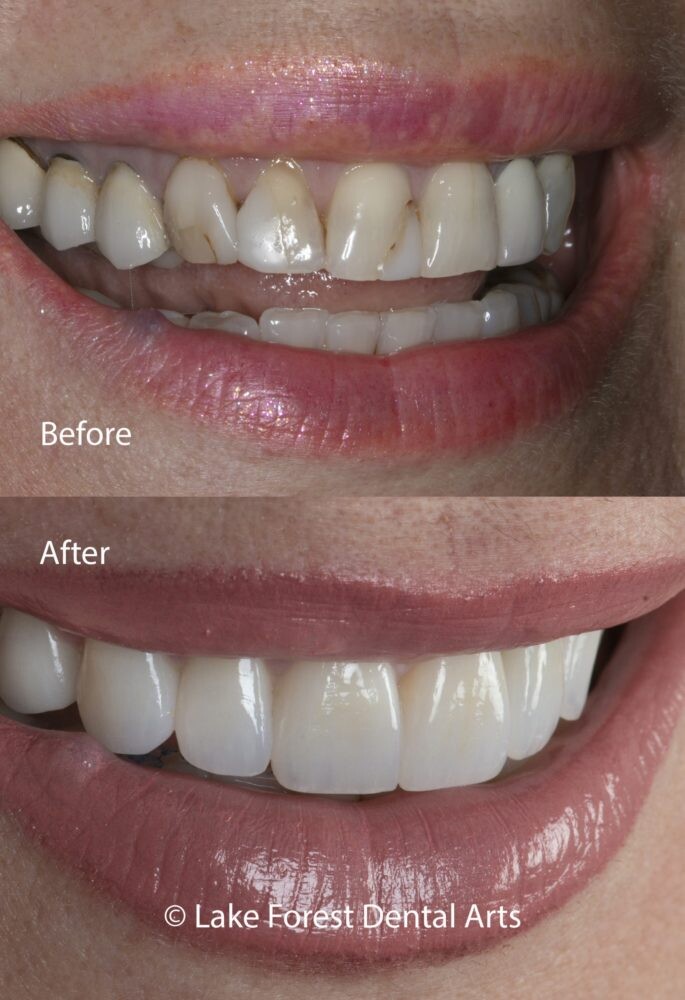 Eximus Dental Zirconia-crowns-before-and-after-scaled-e1581975182887 Zirconia Crowns  